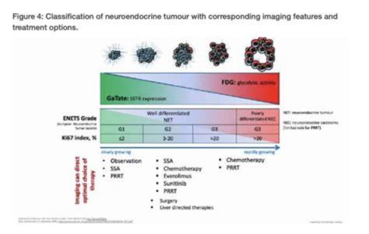Ipsen : Neuroendocrine Tumor (NET) Expert Call