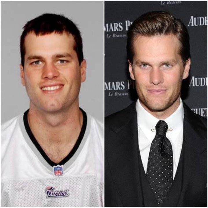 Tom Brady Plastic Surgery